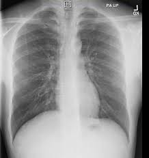 Case contributed by dr brenda lee solorzano frontal chest x ray shows bilateral micronodular insterstitial effusion. Https Www Michigan Gov Documents Mdhhs World Tb Day 2016 Presentations 2 520690 7 Pdf