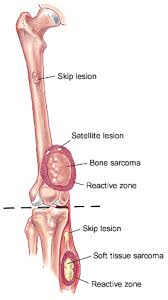 Whether primary or metastatic, cancer in the bones may present with symptoms such as increasing pain, swelling and/or a more sudden intense pain from a pathologic fracture —a fracture that occurs in a bone that has been weakened by the presence of tumor. Osteosarcoma A Multidisciplinary Approach To Diagnosis And Treatment American Family Physician