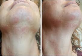 Most cases strike women, although lupus can occur in men, too. Cureus Tumid Lupus Erythematosus And Systemic Lupus Erythematosus A Report On Their Rare Coexistence