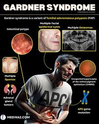 Image result for Gardner Sendromu