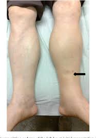 1/3/07 at the docs he said to do quad. Pdf Unilateral Leg Oedema Due To Spontaneous Achilles Tendon Rupture Semantic Scholar
