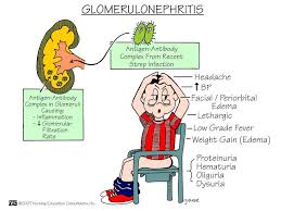 Glomerulonephritis is typical following changes in the urine: Proteinuria Nursing Intervention Detection Of An Increase In Protein Excretion Is Known To Have Both 9ria