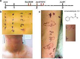 Clinical finding and results of venom immunotherapy in ten patients. Timeline Of Case History And Clinical Pictures Of The Patient With Download Scientific Diagram