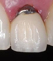 Eine krone ist eine zahnfarbene hochwertige versorgung für beschädigte zähne, die durch einfache füllungen oder inlays nicht mehr zahnkronen gibt es in verschiedenen ausführungen, je nach bedarf bei der professionellen zahnbehandlung. Vollkeramikkrone Optimale Zahnasthetik Und Stabilitat