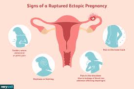 Ruptured Ectopic Pregnancy Emergency Symptoms