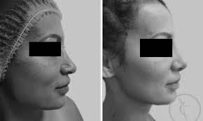 De fapt vreau toate detalile poate si un nr de tel. Poze Rinoplastie Operatii Dr Rachad Art Estetica