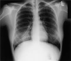 Image result for Acute Bronchitis