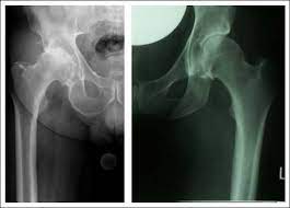 Hufte Arthrose Verschleiss Des Huftgelenks Roland Klinik