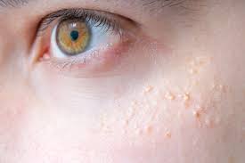 Does Birth Control Help With Acne Pandia Health