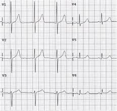 Poor R Wave Progression Prwp Litfl Ecg Library Diagnosis