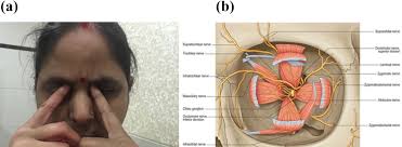 Failure to identify underlying autoimmunity and primary headache disorder  might be the reasons for refractoriness of trochlear headaches