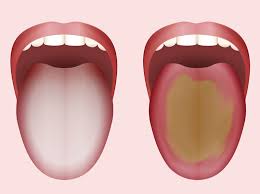 Das hilft gegen pickel auf der zunge pickel auf der zunge können sehr schmerzhaft sein. Belegte Zunge Was Die Farbe Des Zungenbelags Bedeutet Liebenswert Magazin
