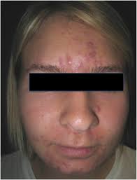 Accutane is indicated for the treatment of severe recalcitrant nodular acne. A Review Of Diagnosis And Treatment Of Acne In Adult Female Patients Sciencedirect