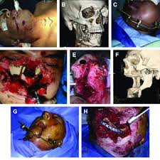 373 x 257 jpeg 16 кб. Pdf Characteristics Of Ballistic And Blast Injuries