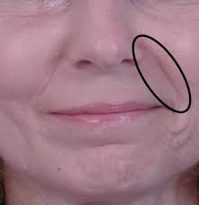 Feb 11, 2021 · multiple fat transfers are often needed. Nasolabial Folds Causes Treatment Exercises And Prevention