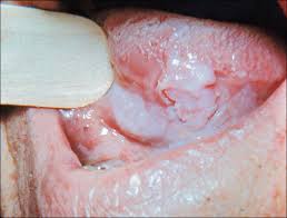 Image result for white cancer on tongue)