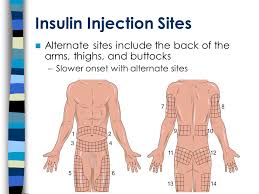 Monitoring of blood glucose levels is frequently performed to guide therapy for persons with diabetes. Injection Administration Techniques Ppt Video Online Download