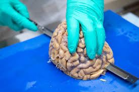 I wonder if oprah asked michael jackson what cte on his shoulders meant when she interviewed him in 1993? Cte Unlocking A Diagnosis To Neurodegenerative Brain Disease