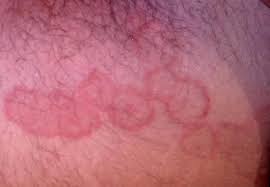 Image result for Eczema nummulare