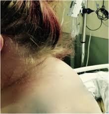 Exogenous Cushing S Syndrome Secondary To Intermittent High Dose Oral Prednisone For Presumed Asthma Exacerbations In The Setting Of Multiple Emergency Department Visits Sciencedirect