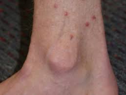 Check spelling or type a new query. Flea Bite Dermnet Nz