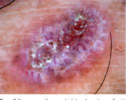 Areas that are exposed to sun such as the forehead, temples and neck are most commonly affected. Figure 4 From Hypertrophic Lichen Planus Versus Prurigo Nodularis A Dermoscopic Perspective Semantic Scholar