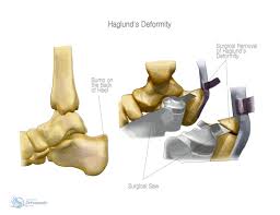 Haglund's deformity, sometimes known as pump bump, is a common condition where a small most exercises and stretches for haglund's deformity focus on relieving stress on the achilles tendon. Haglund S Deformity Orthopaedic James Stanley