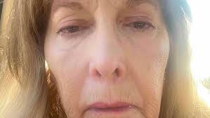 Fundraiser by Andrea J. Feinberg : Support Andrea's Urgent Correcticve  Surgert