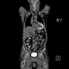Image result for Nuclear Ventriculogram