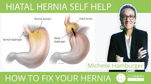 What is a hiatal hernia? Hiatal Hernia Self Help