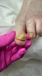 Image result for Onychogryphosis feet