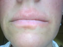 How I Healed The Rash Around My Mouth Zi Zai Dermatology Zi Zai Dermatology