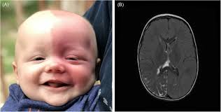 Retrospective analysis of presymptomatic treatment in Sturge–Weber syndrome 