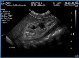 Lesch Nyhan Syndrome Case Report And Review Of Literature