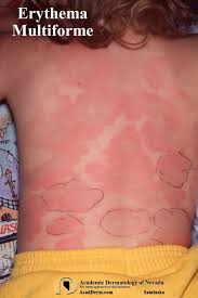 Image result for Erythema Multiforme Major