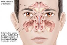 In anatomy, a polyp is an abnormal growth of tissue projecting from a mucous membrane. Ent Sinus Children Otolaryngology Specialists Of North Texas