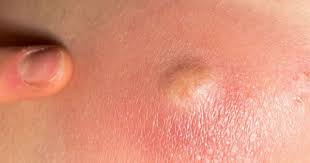 Penyakit bisul merupakan salah satu jenis penyakit yang muncul dipermukaan kulit dan terasa sangat sakit dan cukup menyiksa. 5 Cara Mengatasi Bisul Saat Hamil Dengan Mudah Popmama Com