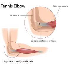 If you still have elbow pain and stiffness after more than 6 to 12 months of rest and rehab, you might think about having surgery. Signs You Have Tennis Elbow What To Do Star Physio