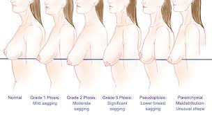 Anatomy Of Breast Ptosis Parker Center For Plastic Surgery