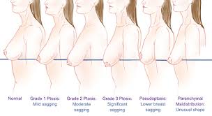 anatomy of breast ptosis parker center for plastic surgery