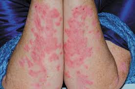 Image result for psoriasis