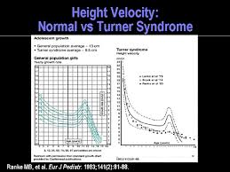 Turner Syndrome Toward Early Recognition And Improved Outcomes