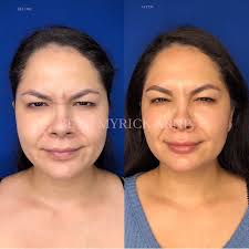 Beth Myrick, ARNP Nurse Injector