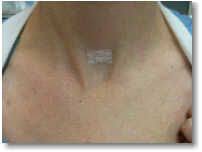 Hyperparathyroidism causes and risk factors. High Blood Calcium Is Never A Good Thing Hyperparathyroid Parathyroid