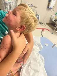 Boy, 2, born with one kidney fights for life after being stung 150 times by  wasps when he bumped into nest on toy car | The US Sun