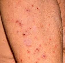 Nach einer durchgemachten infektion mit d. Kratze Symptome Bilder Inkubationszeit Was Tun