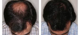 Perdida De Pelo En La Coronilla El Mejor Tratamiento