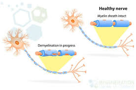 Als is the most common of the five motor neuron disease. Neurogenic Stem Cell Treatment Of Als W Msc Stem Cells
