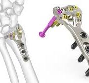 Acu-Loc 2 Wrist Plating System | Acumed