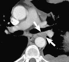 Imaging with fdg pet/mri without si assessment and fdg pet/ct in a . Malignant Pleural Mesothelioma Evaluation With Ct Mr Imaging And Pet Radiographics